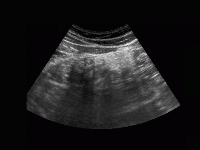 Epiploic appendagitis. Click for animation.