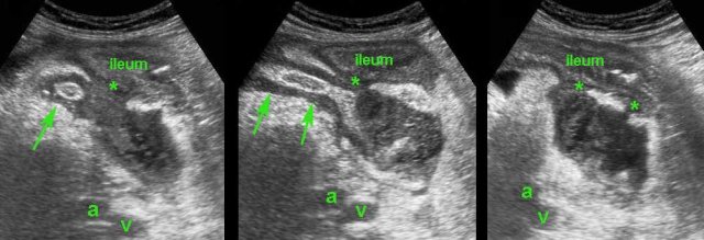 Spontaneous evacuation of appendiceal abscess. a and v = right iliac artery and vein