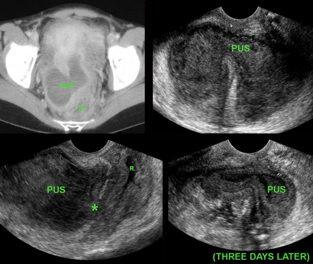 Spontaneous evacuation of postoperative Douglas abscess to rectum.