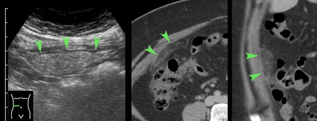 Pitfall: Omental infarction mimicking PID.