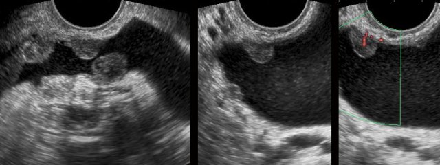 Malignant peritonitis detected by TVUS.