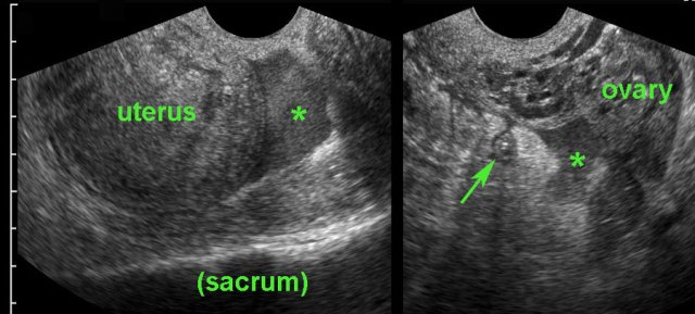 PID with secondarily thickened appendix.