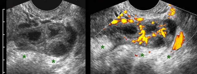 PID: Right sided oophoritis.