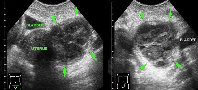 Left sided tubo-ovarian abscess (TOA)