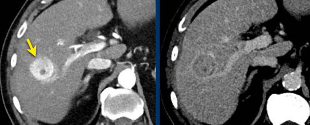 Typical HCC with APHE, washout and enhancing capsule