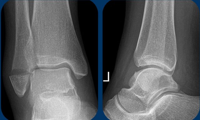 Stage 1: stable ankle fracture