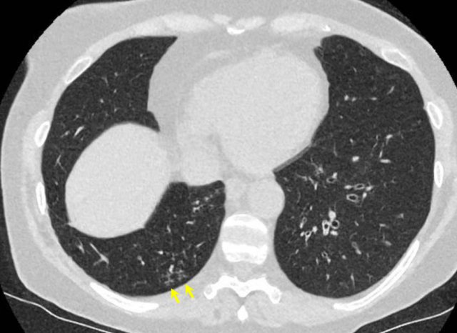 CO-RADS 2. Non COVID-19 infection