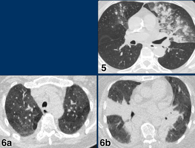 Examples of CO-RADS 3. Click to enlarge.