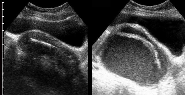 Pyosalpinx associated with IUD.