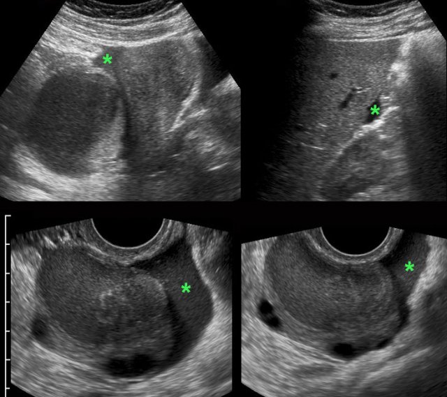 Ruptured endometriotic cyst