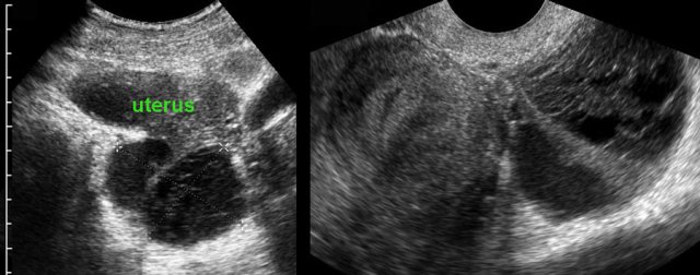 Endometriotic cyst.