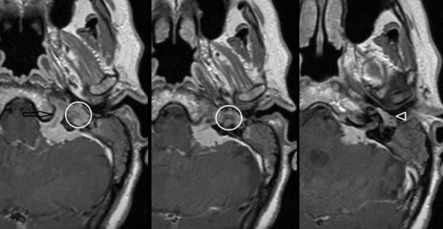 Meningioma