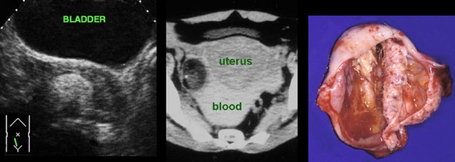 Ruptured dermoid cyst