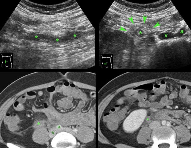 Right ovarian vein thrombosis (*). a and v = iliac artery and vein