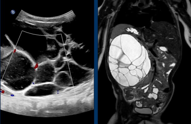 Cystic nephroma