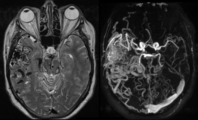 AVM located in the right temporal fossa