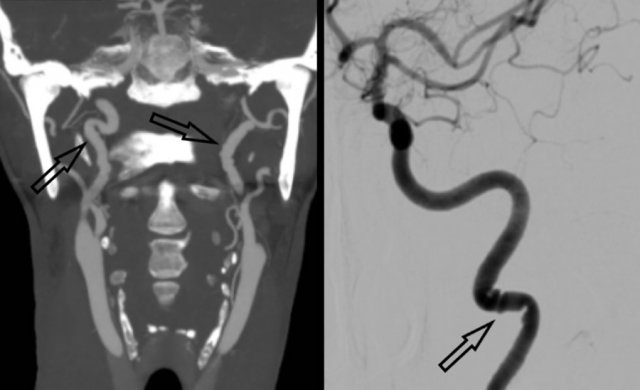 FMD with “string of beads” pattern on MIP CTA and DSA (black arrows)