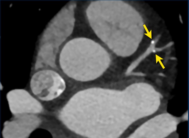 Spotty calcification in the LAD and D1.