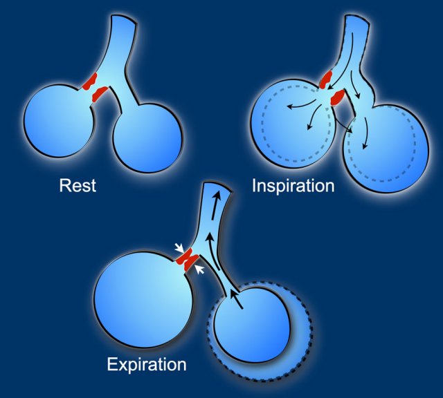 Check-valve mechanism due to tumor cells (in red) in terminal airway