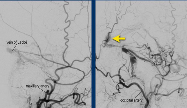 Lateral view of a injection into the distal maxillary artery (left) and occipital artery (right).