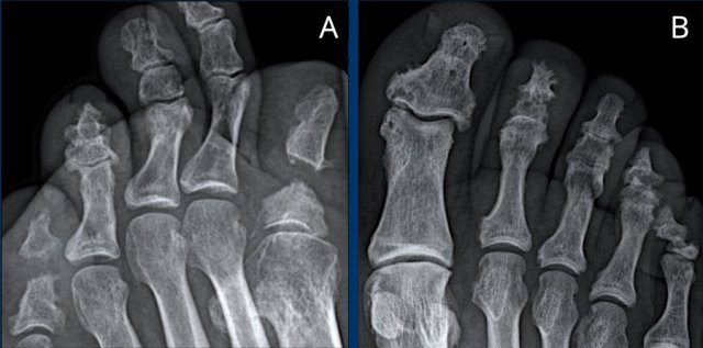 Psoriatic arthritis