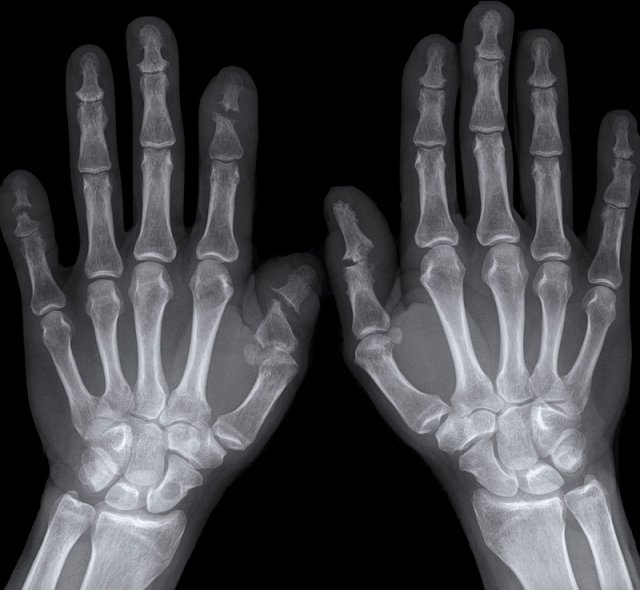 Sausage digits and pencil in cup deformity in Psoriatic arthritis