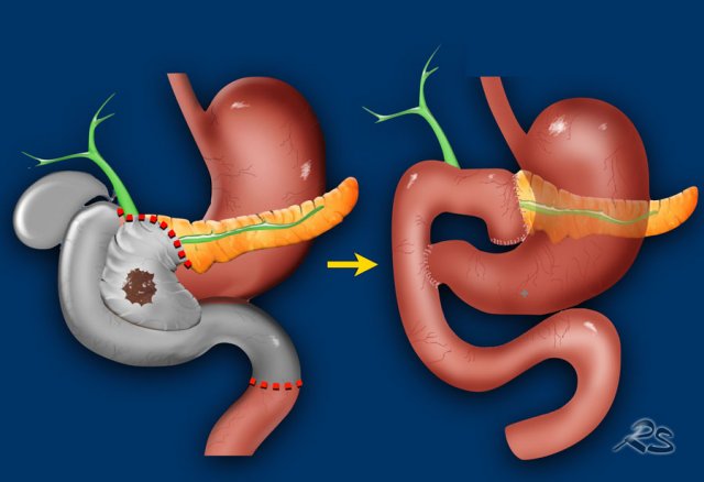 Whipple procedure before and after