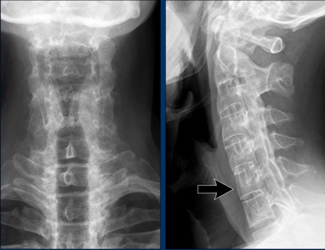 Ankylosing spondylitis of the cervical spine