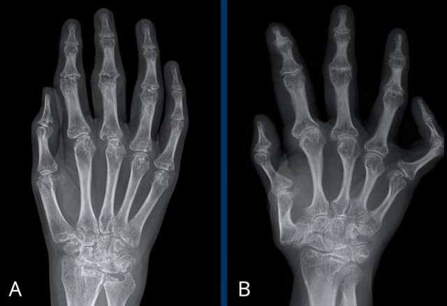 Juvenile arthritis