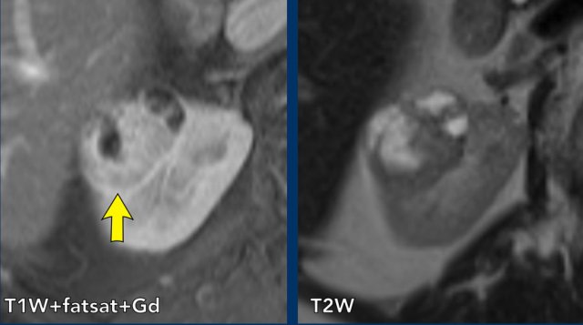 Solid renal tumor with cystic components