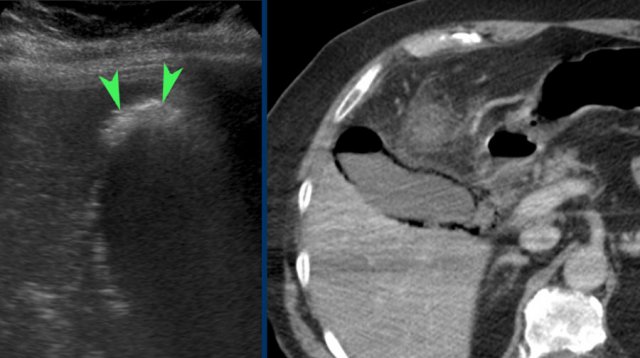 Emphysematous cholecystitis. US shows air in the gallbladder fundus (arrowheads). CT confirms both intraluminal and intramural air.