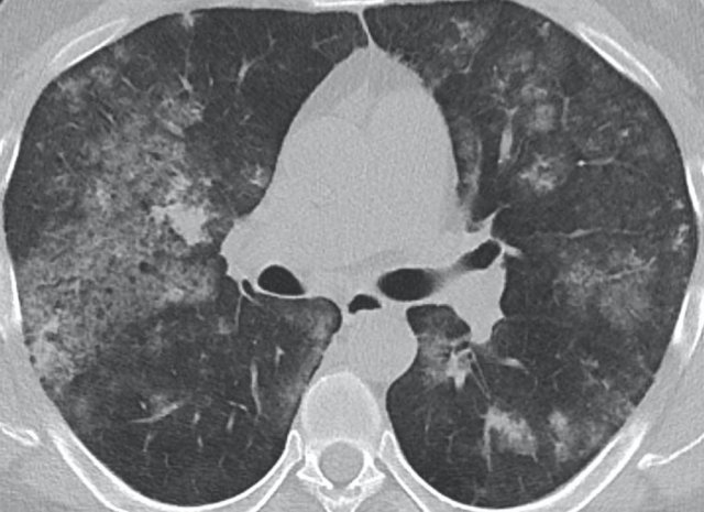 Alveloar hemorrhage in a patient with SLE.