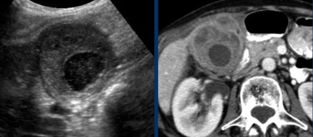 Xanthogranulomatous cholecystitis.