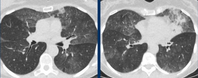 Groundglass and consolidations resembling extensive, bilateral non-mucinous invasive adenocarcinoma and adenocarcinoma in situ.