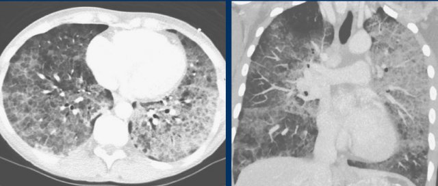 Alveolar proteinosis with diffuse crazy paving