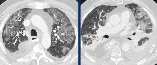 ARDS. Bilateral, in part gravity dependent groundglass with atelectasis, and pleural fluid in a patient who underwent a gastro-esophageal resection.