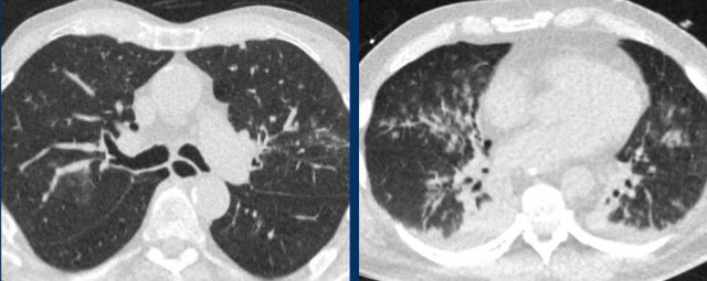 Influenza pneumonia. bilateral groundglass with central distribution and centrilobular groundglass nodules.