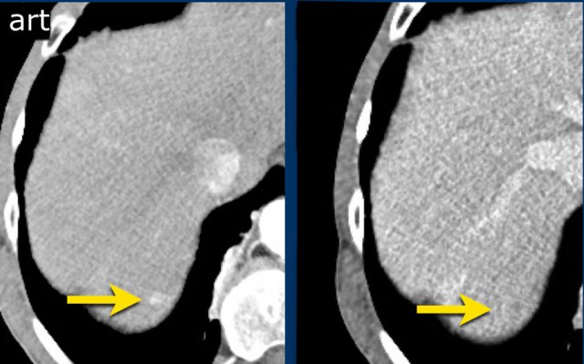 LIRADS 4.  Small area of arterial enhancement and washout posterior in segment 7 measuring 9 mm.