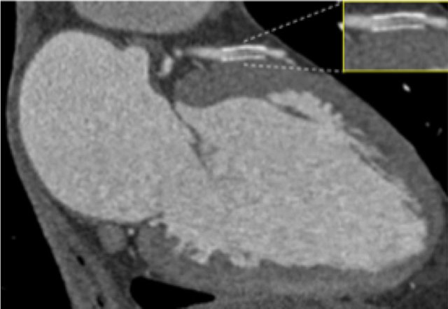 Stent in the mid LAD with minimal in-stent restenosis.