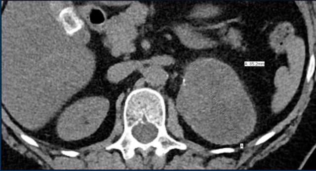 Adrenal leiomyoma