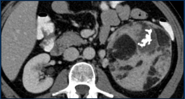 Oncocytoma of the left adrenal with fatty components.