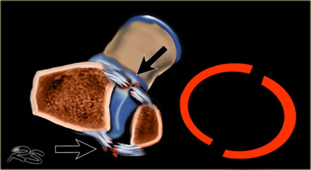 Ring of stability in the axial plane