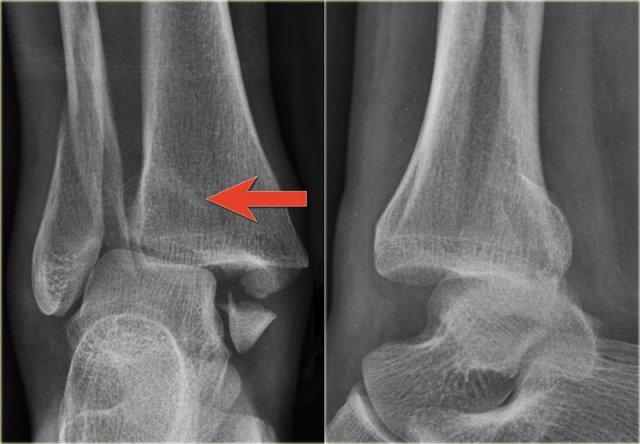 Trimalleolar Weber B fracture