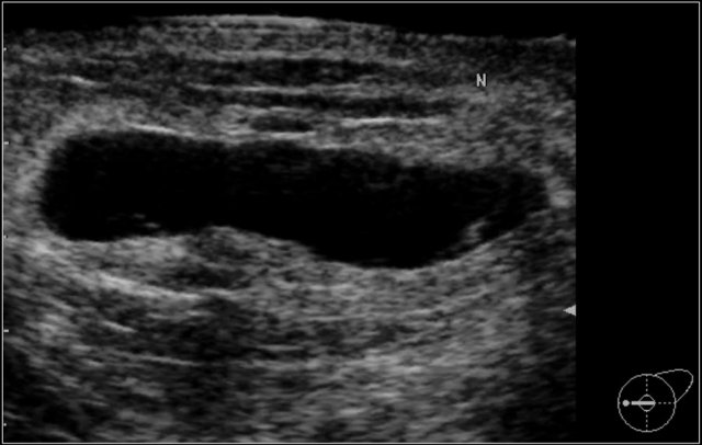 BI-RADS Category 2: Mass seen on mammogram proved to be a cyst.