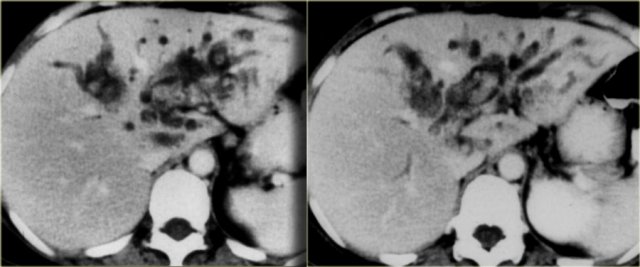 Recurrent pyogenic cholangitis of the left lobe with intrahepatic stones