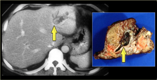 Recurrent pyogenic cholangitis with resected specimen