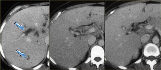 Primary sclerosing cholangitis. CT findings