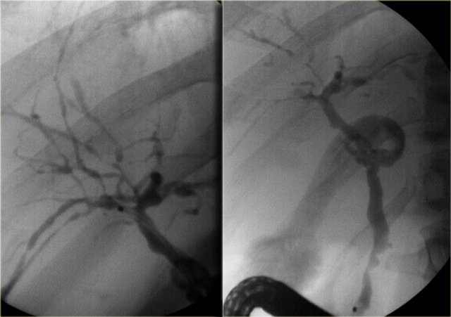 Primary sclerosing cholangitis. Cholangiographic findings