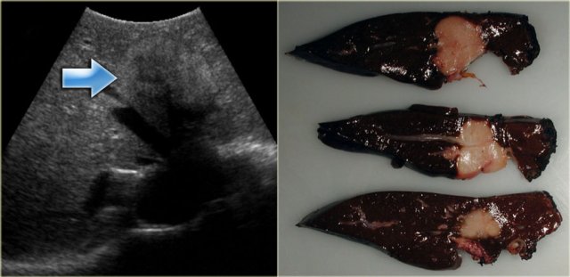 Intrahepatic cholangiocarcinoma. RadPath correlation