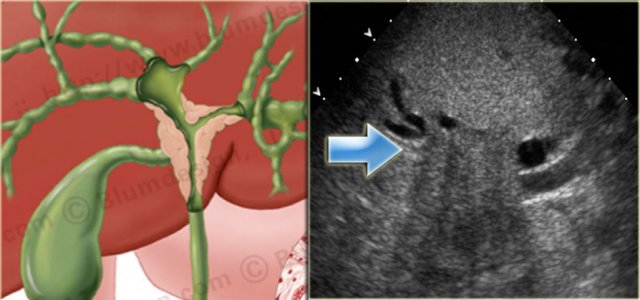 Klatskin Tumor with dilatation of bile ducts in the right and left lobe of the liver Illustration by Heike Blum